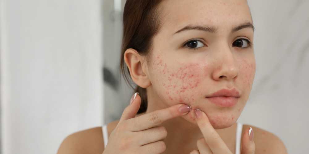 What are the different types of acne?