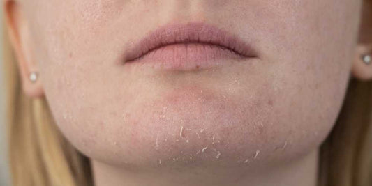 What causes dry skin?